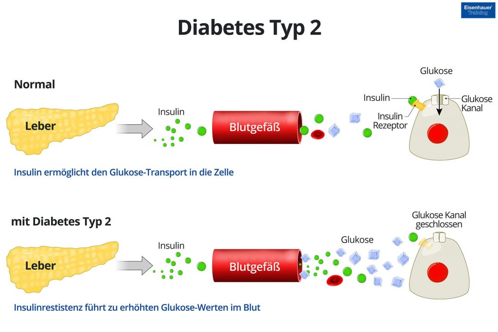 Diabetes Typ 2 Diagramm
