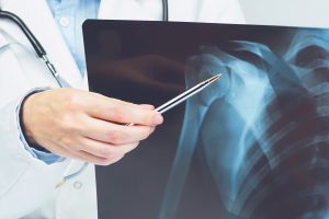 Ein Röntgenbild zeigt das Skelett, nicht Muskulatur und Gewebe