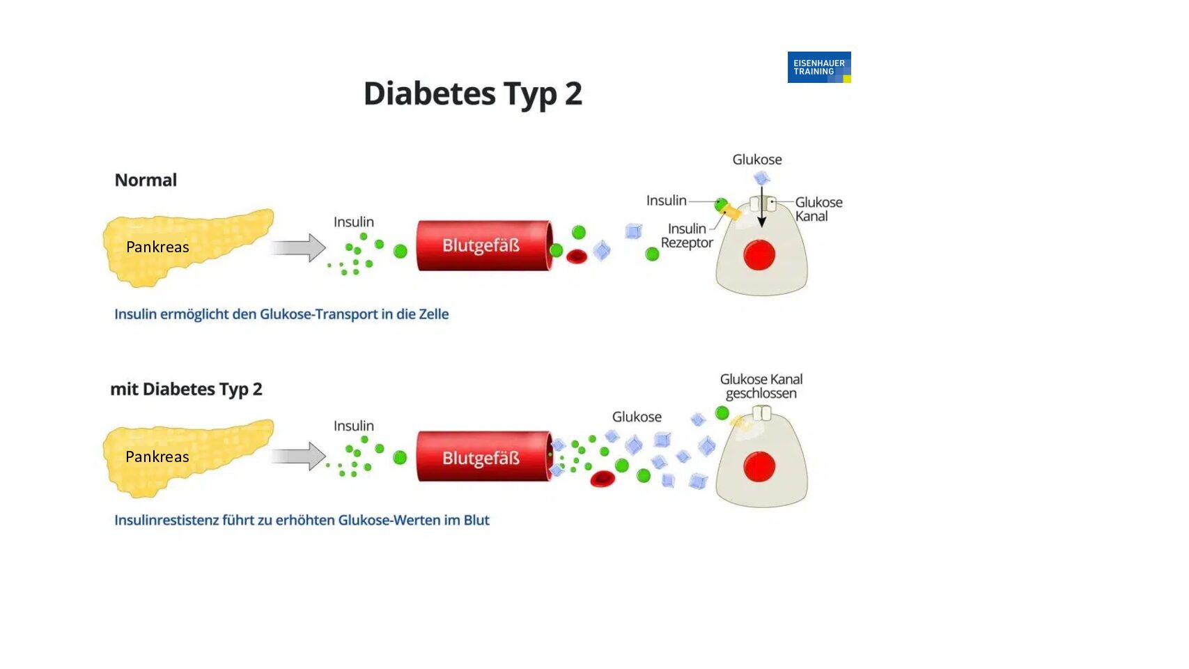 Trainingsplan für Diabetiker Typ 2 - Eisenhauer Training